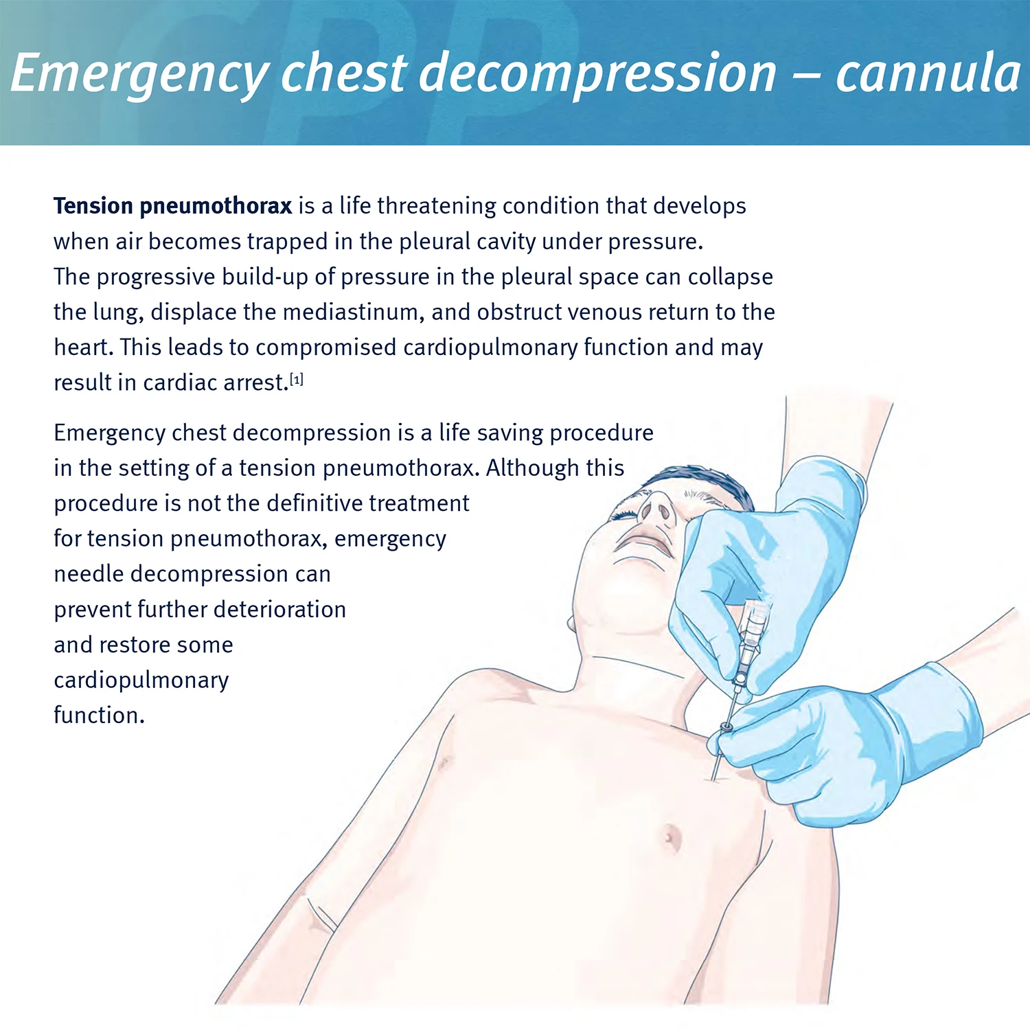Sanke Rescue Pneumothorax Needle Trauma Medical Ifak Chest Cathether Needlecatheter 50g Needle Decompression Edc First Aid Kit - Image 6